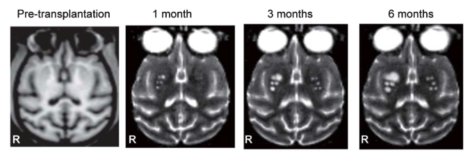 iPSC-derived dopamine neurons